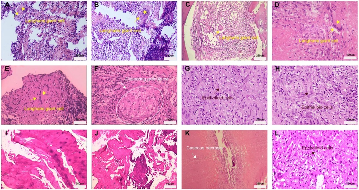 Histopathological features of STB. Representative H&E images from STB lesions. Panels (A-L) were selected from different STB patients to illustrate recurrent lesion-level pathological patterns observed in the cohort. The annotations indicate representative histopathological features: yellow arrows and asterisks indicate multinucleated/Langhans-type giant cells; white arrows and circles indicate caseous granulomas; and brown-red arrows indicate epithelioid cells.