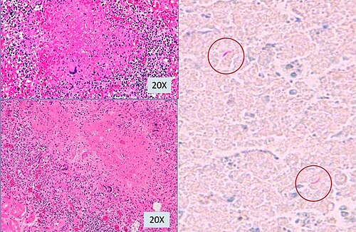 Histopathology of miliary tuberculosis having caused the death of a 82-year-old female. It shows epithelioid granulomas with multinucleated giant cells (H & E stain) from kidney and spleen micronodules (left images) with acid-fast bacilli.