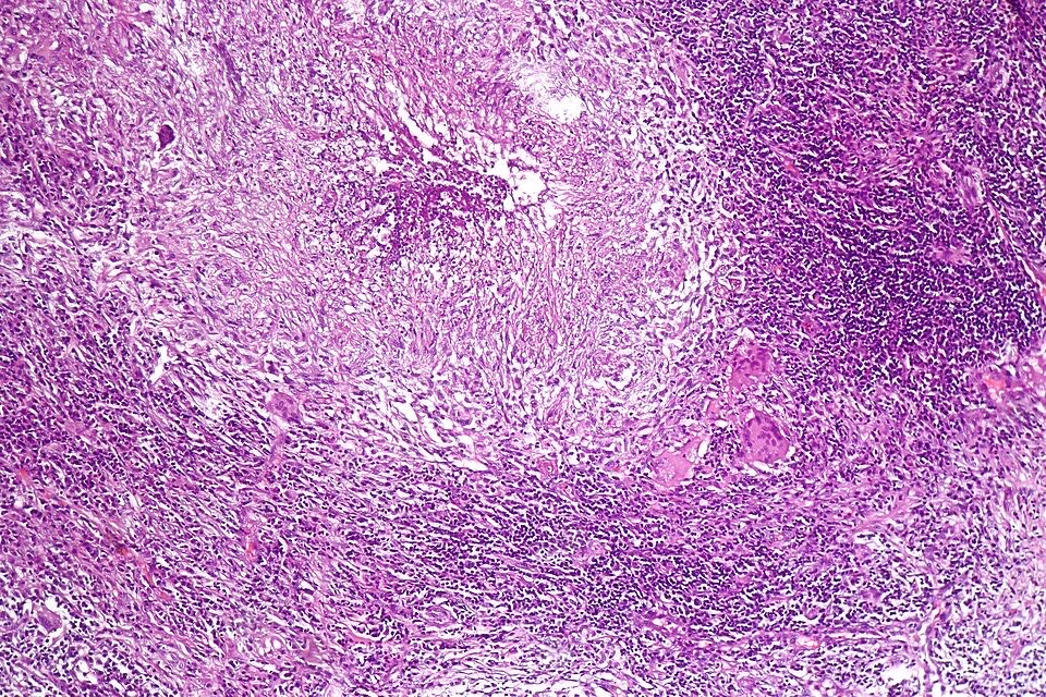 Pulmonary tuberculosis characterized by granulomatous inflammation with necrotizing epithelioid granulomas. H&E stain.