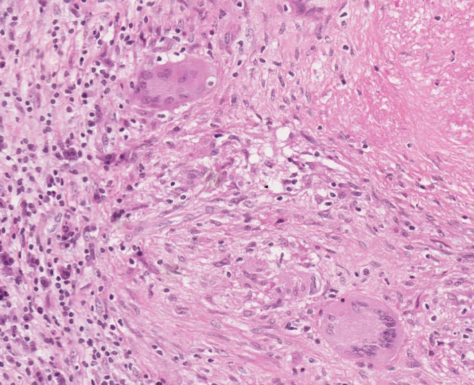 Tuberculoid granuloma associating epithelioid cells, Langhans' multinucleated giant cells and caseous necrosis (upper right)