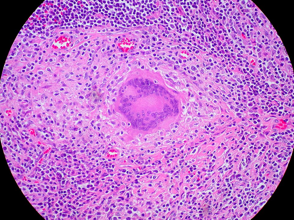 Presiding over a noncaseating granuloma.