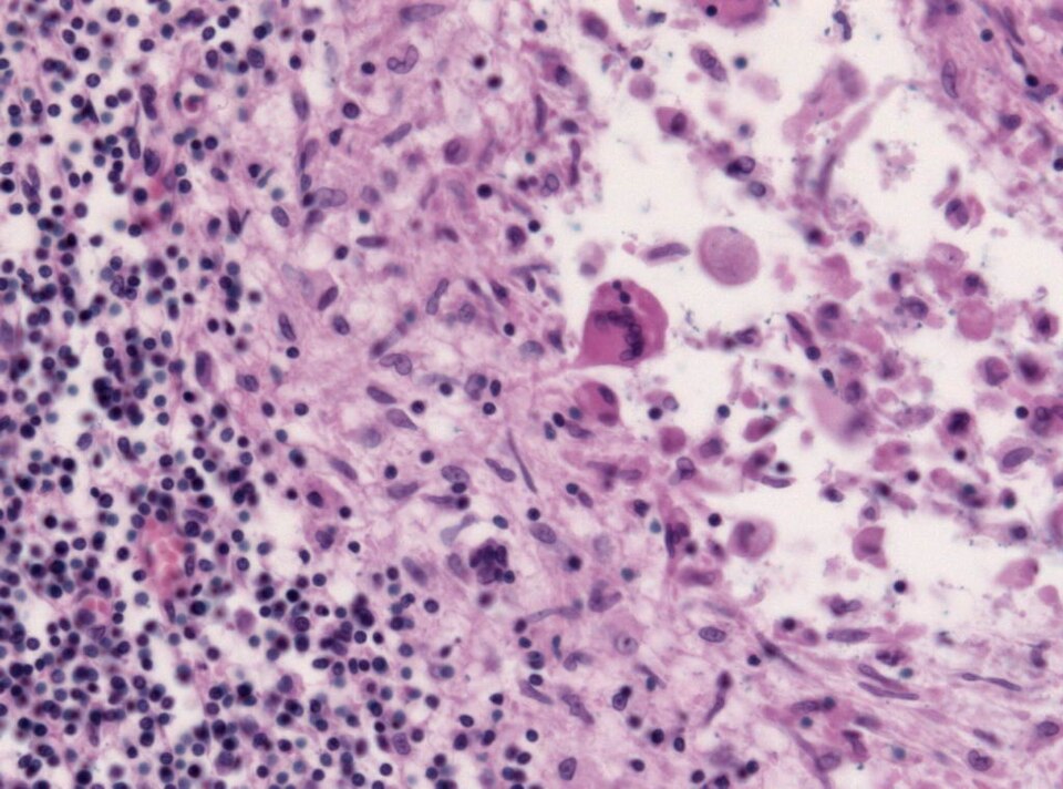 Histopathology specimen of tuberculous meningitis - HE stain