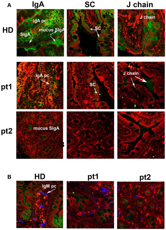 IgA+ plasma cells in human duodenal lamina propria (healthy donor). Cryostat sections stained with anti-IgA (green). IgA+ plasma cells are visible in normal lamina propria; splenectomized patients show reduced IgA+ plasma cells in the same tissue.