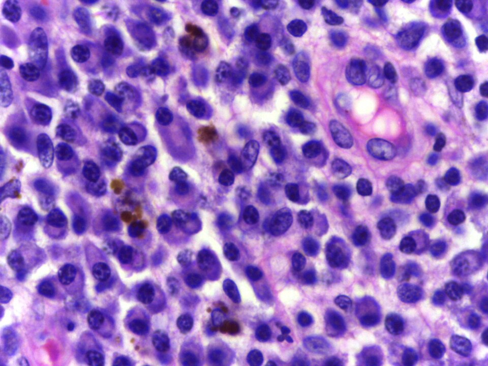 Plasma cell showing eccentrically placed round nucleus with cartwheel chromatin pattern. Stain not specified; chromatin clumping is consistent with Wright or Giemsa.