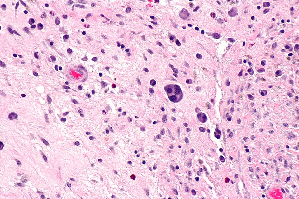 Multinucleated plasma cell, H&E stain, high magnification. An atypical morphological variant; normal plasma cells are mononuclear.