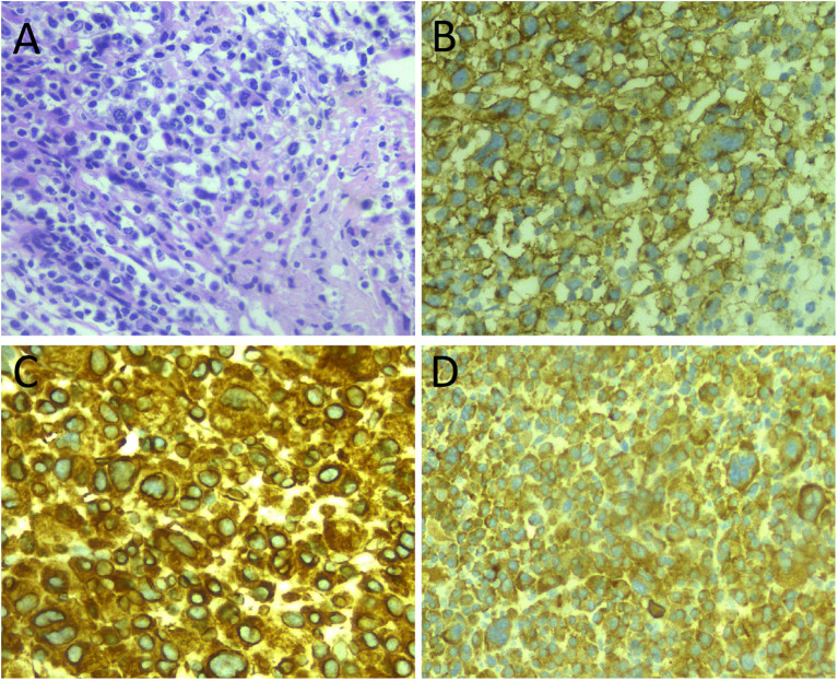 Haematoxylin and eosin staining of a solitary plasmacytoma of the tibia showing sheets of malignant plasma cells infiltrating bone marrow. Figure 1 from Hu X et al.