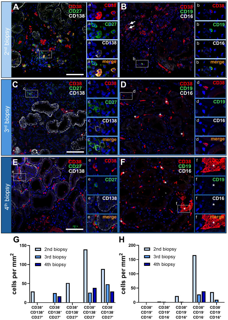 Multiplex immunofluorescence staining in sequential kidney biopsies. Using two multiplex immunofluorescence assays CD38-CD138-CD27 (A, C, E, G) and CD38-CD19-CD16 (B, D, F, H) revealed changing phenotypes of immune cells across consecutive biopsies. Representative images, including magnified regions of interest with separate detection channels were shown for 2nd (A, B), 3rd (C, D) and 4th (E, F) biopsies using a Zeiss LSM710 confocal laser scanning microscope (Zeiss, Oberkochen, Germany) with a 20x objective. From every section, 4-5 representative images per biopsy were subsequently analyzed for the frequency of immune cell subsets using QuPath software showing the mean cell counts per mm 2. White arrows indicate CD16+ cells (B). *in addition, CD38+ material colocalized with diffuse DAPI (4',6-diamidino-2-phenylindole) staining, indicating broken or lysed CD38+ cells.