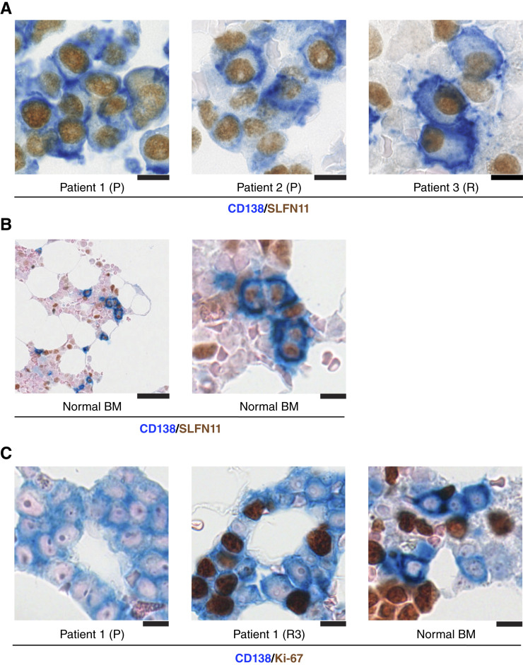 Expression of SLFN11, CD138, and Ki-67 in multiple myeloma (MM) patient samples and normal bone marrow. A, Representative dual immunohistochemical staining for CD138 (blue, membrane) and SLFN11 (brown, nuclear) in bone marrow samples from patients with MM. Patients 1 and 2 are primary (P; newly diagnosed), whereas patient 3 (R) represents a sample from a recurrent patient. 81%-98% CD138-positive myeloma cells express SLFN11. B, Dual immunohistochemical staining for CD138 (blue) and SLFN11 (brown) in normal bone marrow. Left, low magnification. Right, high magnification of the same field. Normal bone marrow contains 5.5%-6.8% plasma cells, of which 72%-85% demonstrate SLFN11 positivity, indicating that SLFN11 expression is an intrinsic feature of NPCs. Scale bars, 50 um (left) and 10 um (right). C, Representative dual immunohistochemical staining for CD138 (blue) and Ki-67 (brown, nuclear) to assess proliferative activity. Left and middle, patient 1 at primary diagnosis (P) and third relapse (R3), respectively. Right, normal bone marrow. The PCPI, defined as the percentage of CD138-positive cells coexpressing Ki-67, is markedly elevated in myeloma specimens compared with normal bone marrow, with further increases observed at relapse. Scale bars, 10 um. BM, bone marrow.