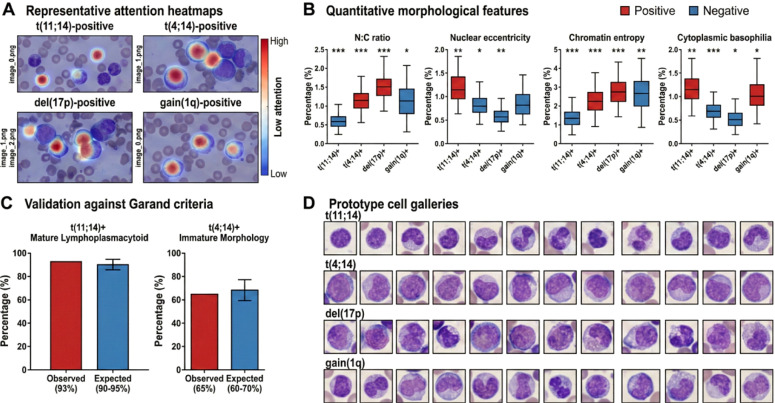 Bone marrow aspirate smears of myeloma plasma cells stained with Wright-Giemsa, 1000x. Attention heatmap overlay (blue to red) shows cells driving a deep-learning subtype classifier. Four cytogenetic subtypes shown: t(4;14), t(11;14), del(17p), gain(1q).