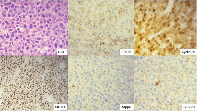 Bone marrow biopsy H&E stain (x40 objective). Immunostaining was positive for CD138 (x40 objective), cyclin D1 (x40 objective), MUM1 (x20 objective), and negative for kappa and lambda staining (x40 objective).