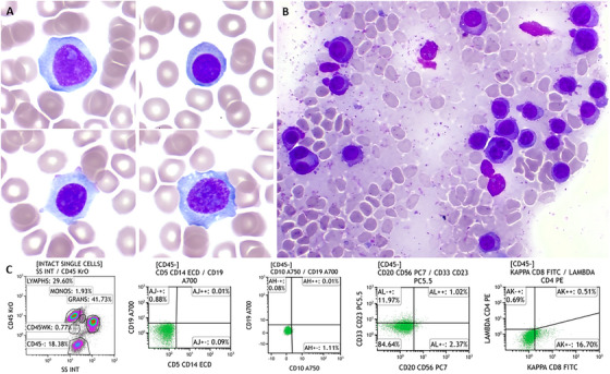 (A) Blood film (x100 objective) showed large atypical plasma cells, some with prominent nucleoli and plasmablast morphology; (B) bone marrow aspirate (x40 objective) showed background staining and heavy infiltration of plasma cells with atypical binucleated forms; (C) peripheral blood immunophenotyping showing a population (green colour) of cells that are CD45-CD5-CD19-CD20-CD56-CD33-CD23-Ig-.