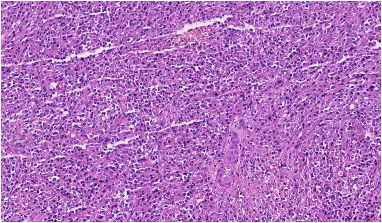Histopathology of the rib lesion shows dense sheets of plasma cells with eccentric nuclei, clumped chromatin, and a perinuclear hof, consistent with a monoclonal plasma cell infiltrate (H&E, original magnification x20).