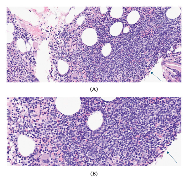 H&E staining of BM biopsy showing interstitial lymphocytic infiltrates. (A) 20x magnification. (B) 40x magnification.